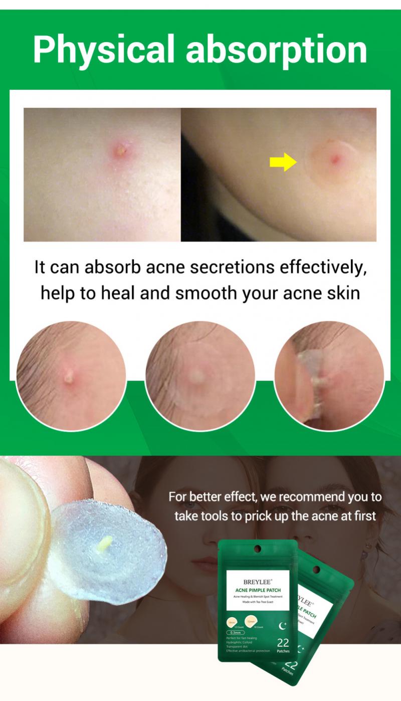 Acne Pimple Patch Sticker Acne Treatment Pimple Remover Tool Blemish Spot Facial Mask Skin Care маска для лица