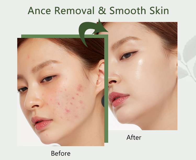 Acne Treatment Facial Mask Natural Tea Tree Pore Cleaning Blackhead Remove Oil Control Pimple Skin Care Products Face Clay Mask